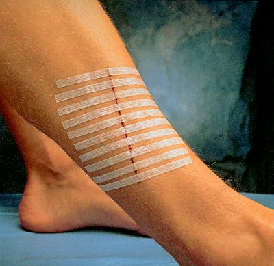 Skin Closure Strip Suture Strip - Box